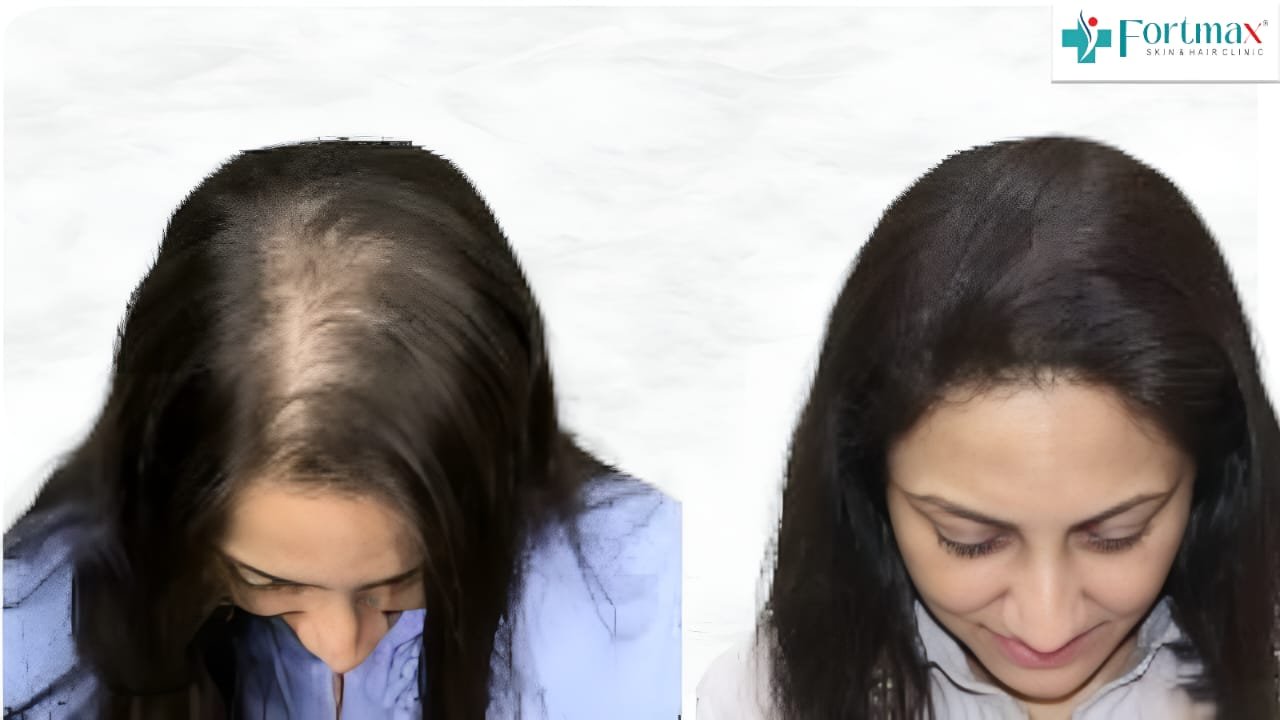 Female-hair-transplant