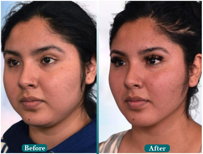 Female-hair-transplant