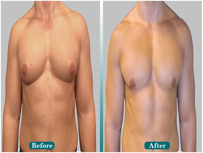 Corrective-hair-transplant